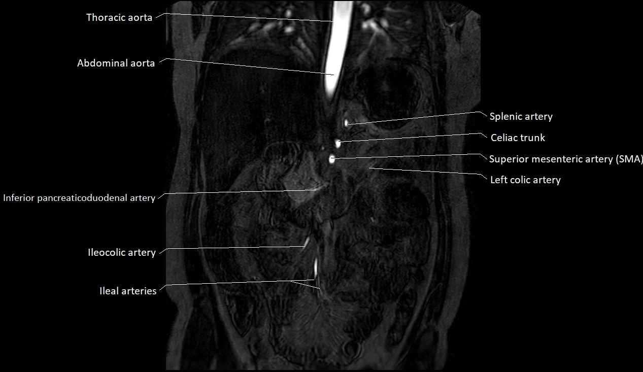 MRA Abdomen coronal anatomy image 14.webp